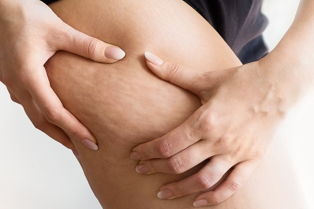 Mujer pellizcando la piel del muslo para comprobar la celulitis y sus fases